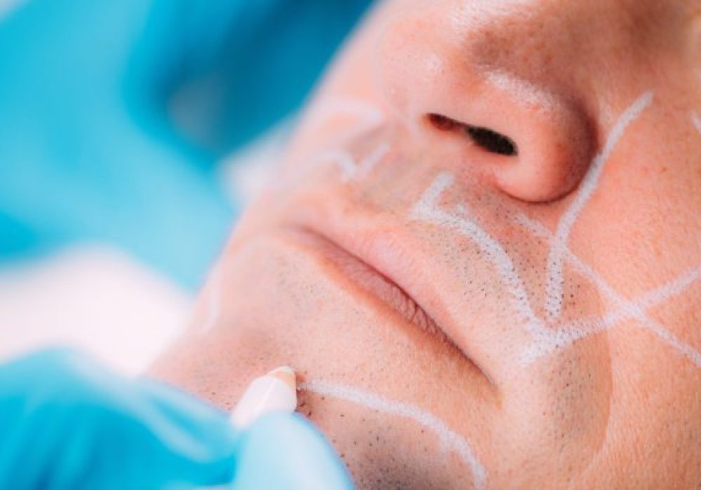 dermal-fillers-for-men-marking-man-s-face-before-2024-10-21-09-29-07-utc-scaled-r87sqk2u3vlgly6rng8jab1agoigso7t6vusg8rteo